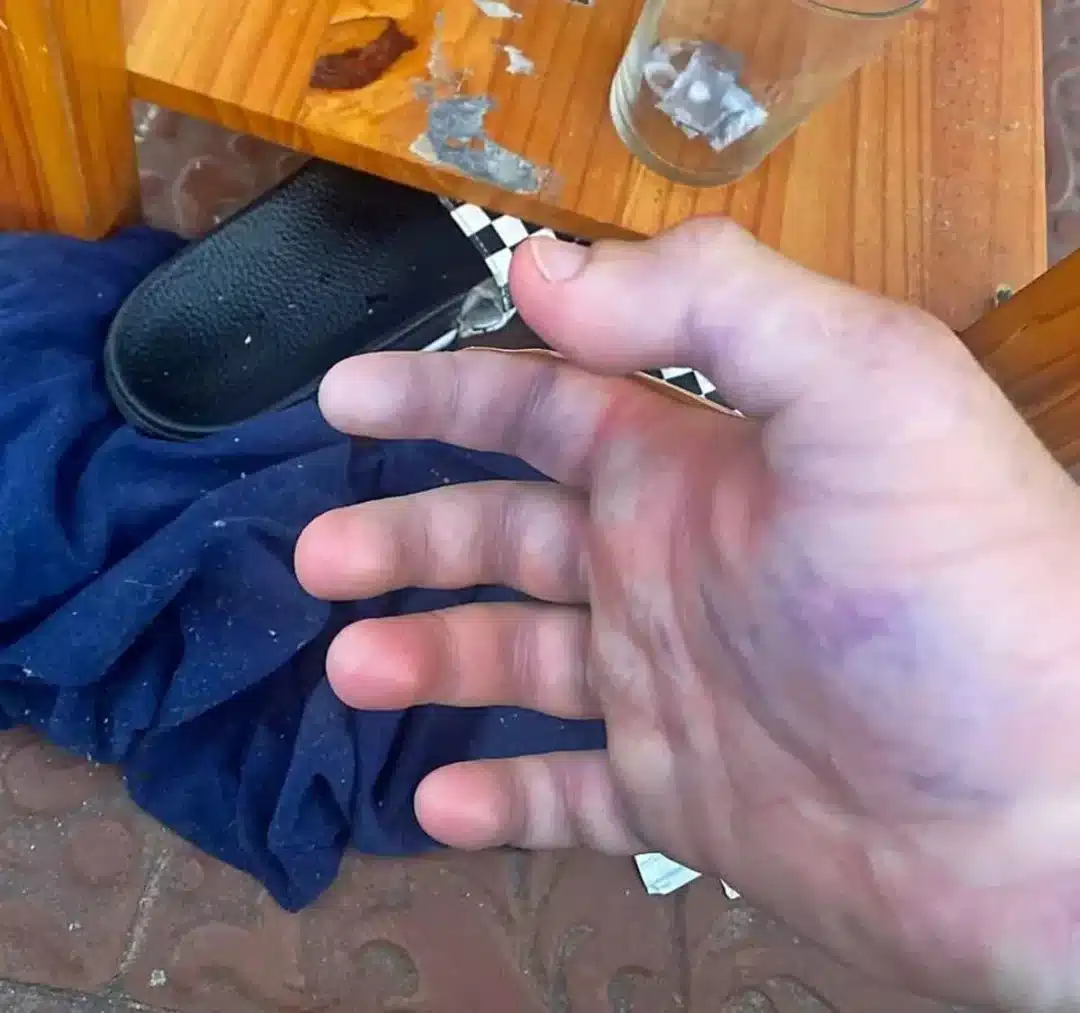 Violin Spider Bite In Ibiza-2