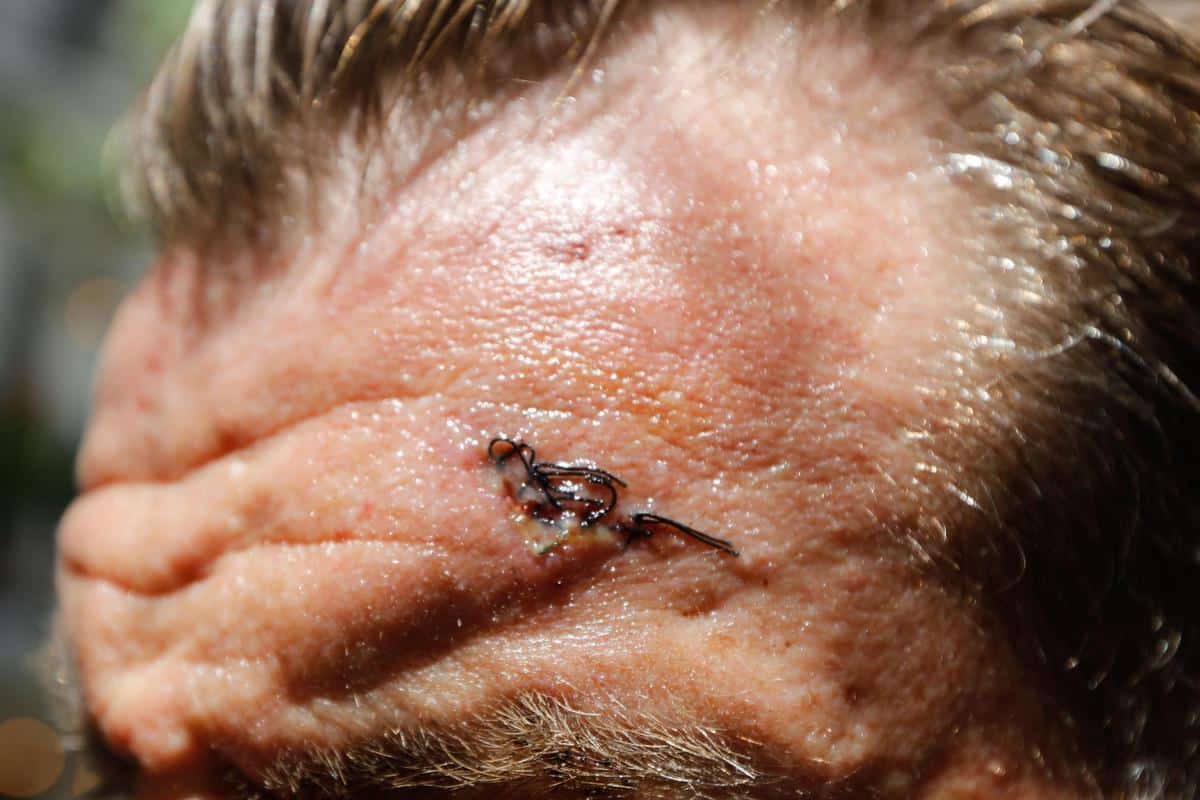 One of the injured, with six stitches in his forehead.