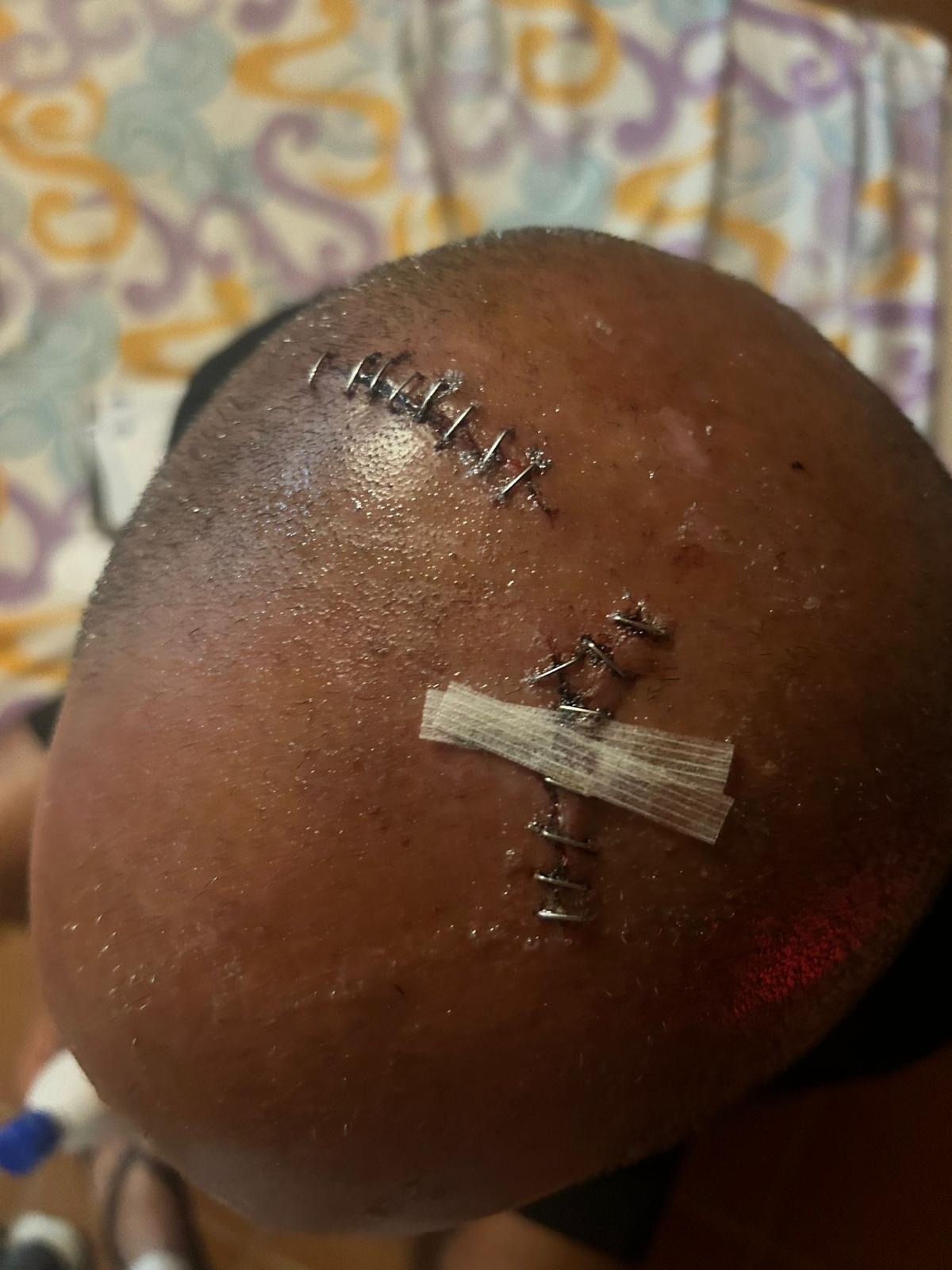 Another of the wounded, with 16 stitches in the head.